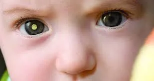 Retinoblastoma tem como principa sinal o reflexo esbranquiçado ou amarelado no olho, é principal alerta desse tumor

Foto: Reprodução