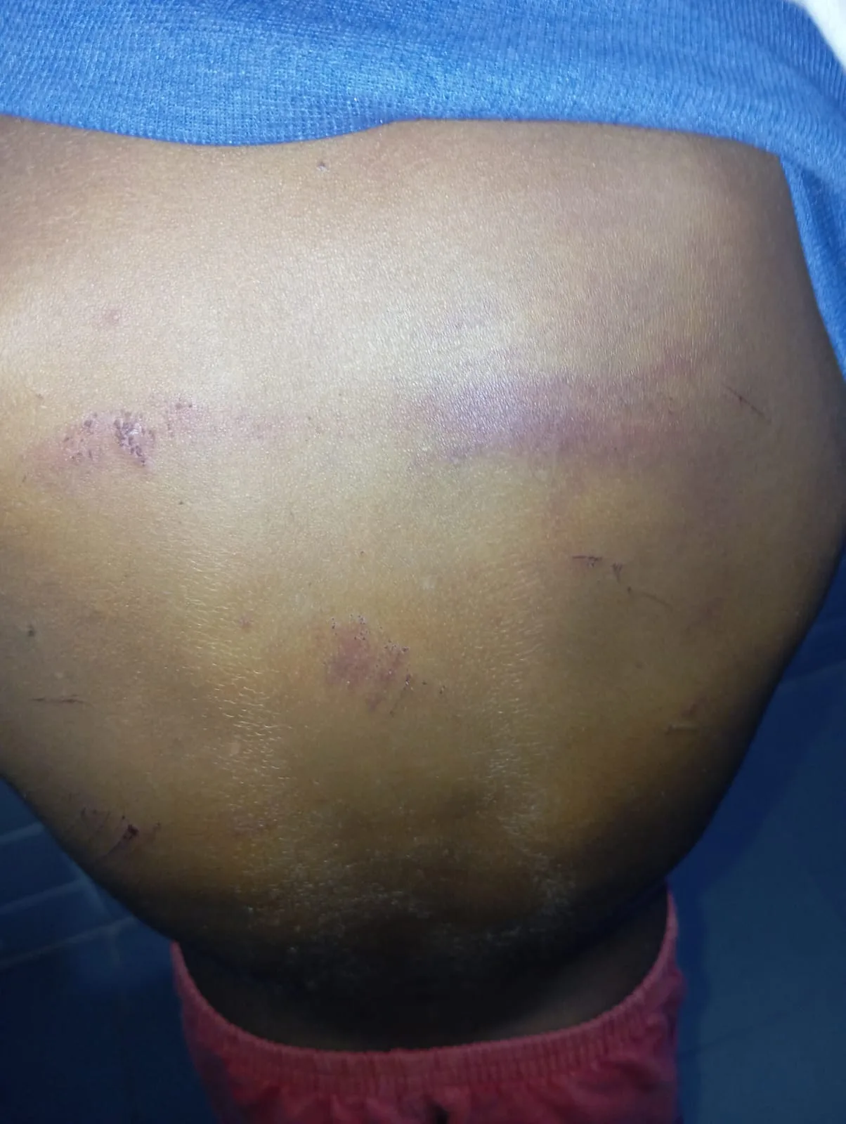 A criança tinha vários hematomas pelo corpo