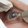 Na operação de catarata, o médico retira o cristalino opaco e introduz uma lente intraocular que devolve a visão normal ao paciente.