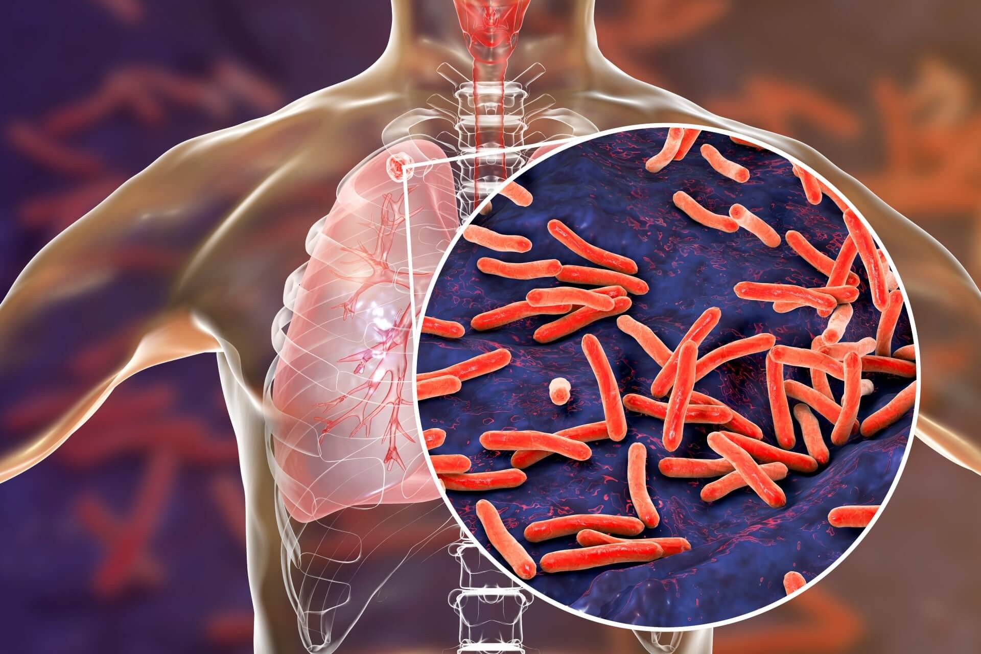 Dados da Secretaria Estadual de Saúde Pública do Pará (Sespa) revelam que, em 2024, 5.600 pessoas foram diagnosticadas com tuberculose no estado