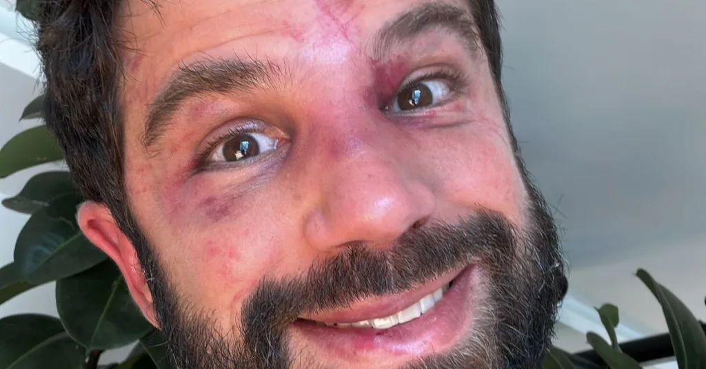 Duda Nagle completou 42 anos em grande estilo --e com o rosto bastante machucado. O ator, e ex-marido de Sabrina Sato, encarou Acelino "Popó" Duda Nagle completou 42 anos em grande estilo --e com o rosto bastante machucado. O ator, e ex-marido de Sabrina Sato, encarou Acelino "Popó"