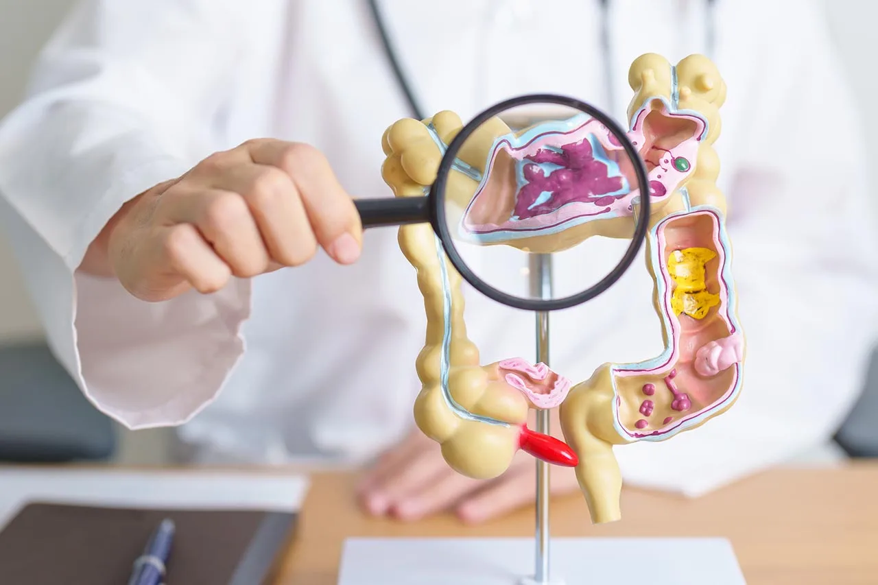 Exame de fezes pode detectar até 90% dos cânceres de intestino