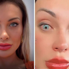 Andressa Urach sofre complicações após mudar cor dos olhos na França