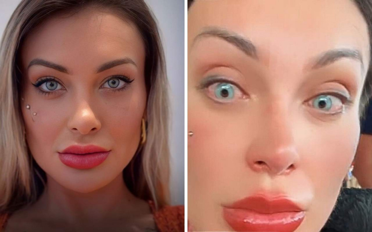Andressa Urach sofre complicações após mudar cor dos olhos na França