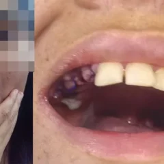 Uma jovem autista, moradora de Belém, teve 17 dentes extraídos sem a autorização da família durante atendimento odontológico
