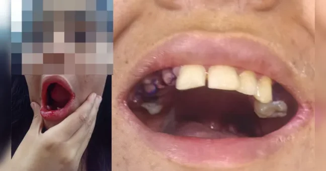 Uma jovem autista, moradora de Belém, teve 17 dentes extraídos sem a autorização da família durante atendimento odontológico