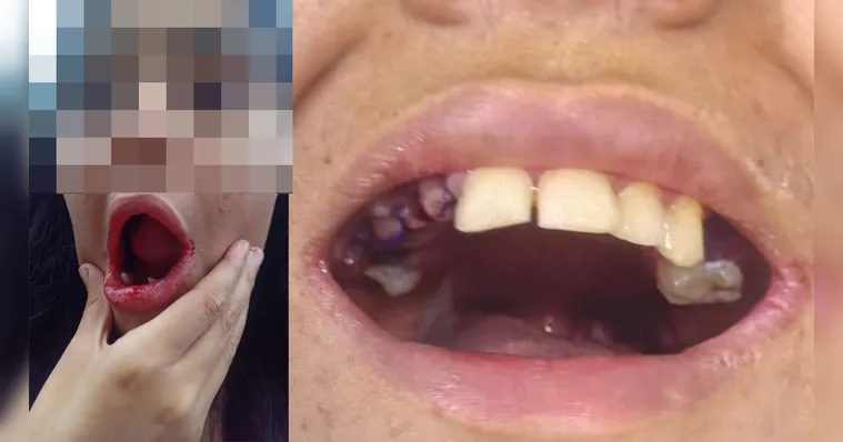 Uma jovem autista, moradora de Belém, teve 17 dentes extraídos sem a autorização da família durante atendimento odontológico