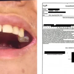 Adolescente com TEA teve 13 dentes extraídos com consentimento da mãe, confirma documento