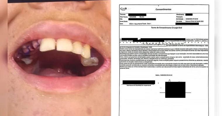 Adolescente com TEA teve 13 dentes extraídos com consentimento da mãe, confirma documento