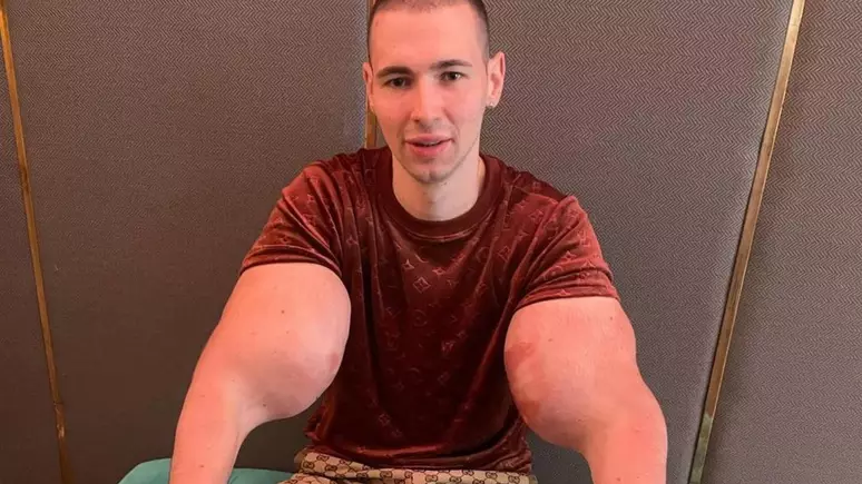 Kirill Tereshin, conhecido como "Popeye Russo", tem chamado a atenção dos seus seguidores após decidir remover as substâncias que aplicou nos braços