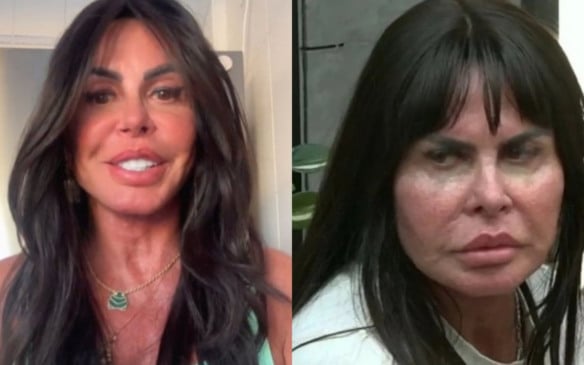 Gretchen voltou a surpreender os fãs ao revelar o resultado de sua nova harmonização facial nesta terça-feira (29).