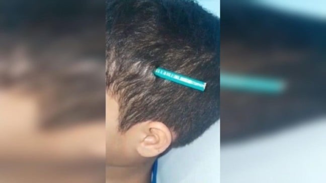 Menino de 9 anos é hospitalizado após colega cravar lápis em sua cabeça dentro de escola em SP