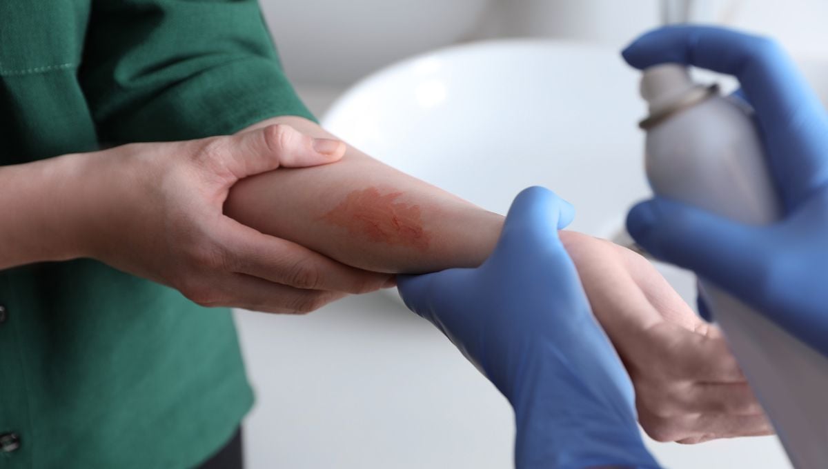SUS terá transplante de membrana amniótica para tratamento de queimaduras