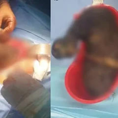 Com dores e vômitos, jovem é diagnosticada com síndrome de Rapunzel e submetida a cirurgia