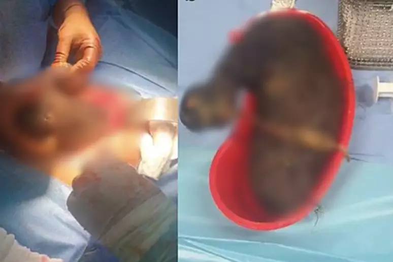 Com dores e vômitos, jovem é diagnosticada com síndrome de Rapunzel e submetida a cirurgia