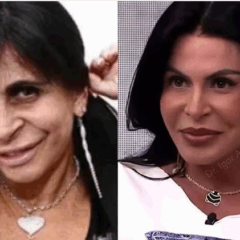 Aos 66 anos, Gretchen combina blefaroplastia, colágeno e preenchimento permanente com PMMA.Aos 66 anos, Gretchen combina blefaroplastia, colágeno e preenchimento permanente com PMMA.