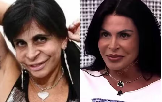 Aos 66 anos, Gretchen combina blefaroplastia, colágeno e preenchimento permanente com PMMA.Aos 66 anos, Gretchen combina blefaroplastia, colágeno e preenchimento permanente com PMMA.