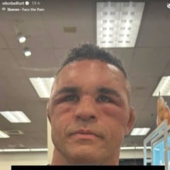 Vitor Belfort aparece com a cara desfigurada após implante capilar