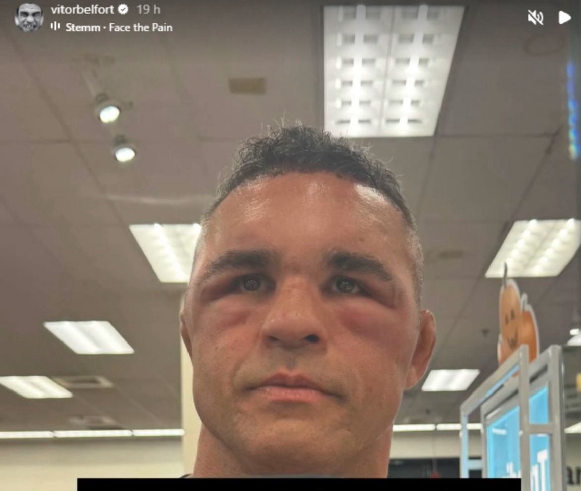 Vitor Belfort aparece com a cara desfigurada após implante capilar