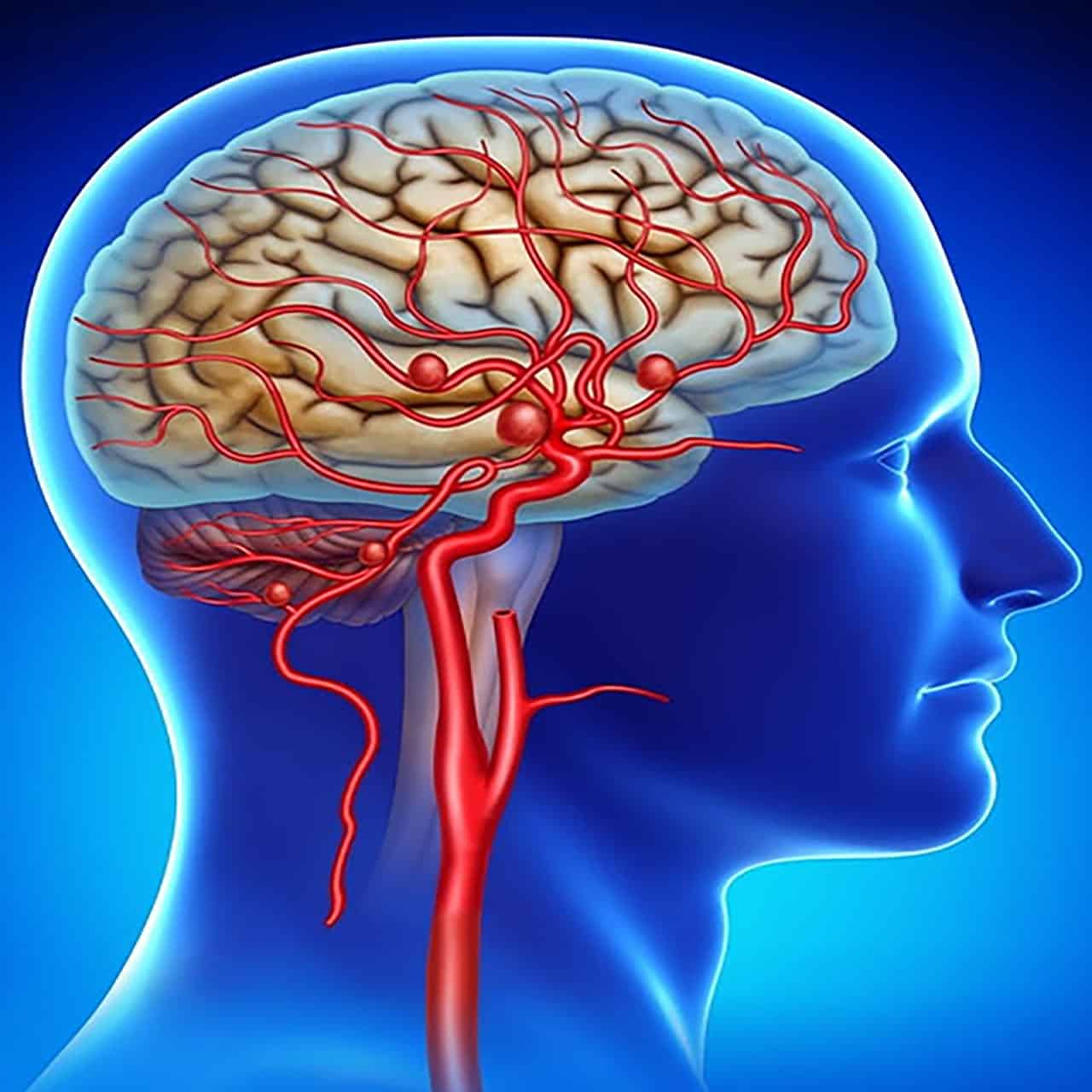Acidente Vascular Cerebral pode ser evitado com diagnóstico precoce.
