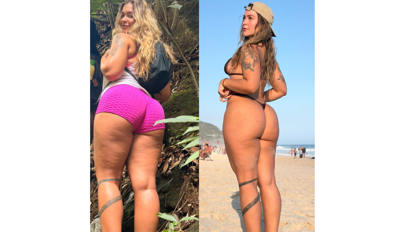 Miss Bumbum 2026 revela diagnóstico de lipedema após notar mudança no corpo; entenda