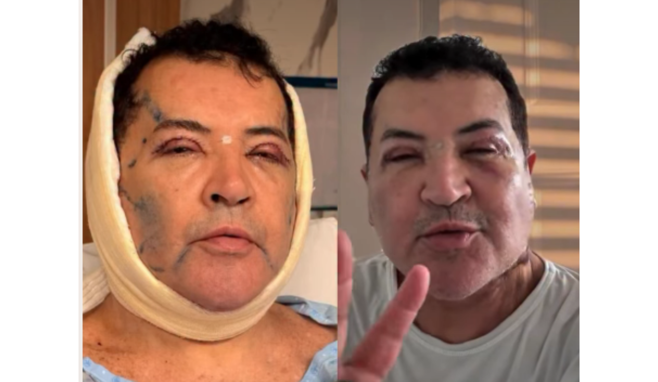 Beto Barbosa muda o rosto aos 71 anos e mostra pós-operatório; vídeo